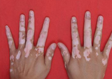 手部白斑病的原因有哪些